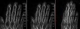MRA 2D - hand